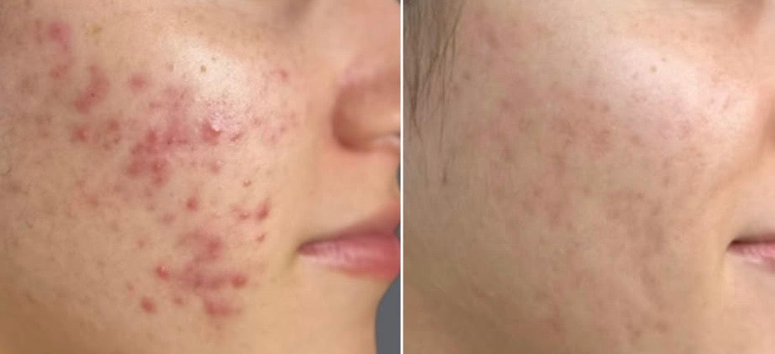Before and after comparison of acne on a person's face.