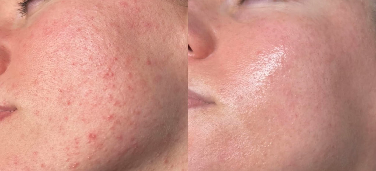 Before and after comparison of a person's face with acne on the left and smooth skin on the right.
