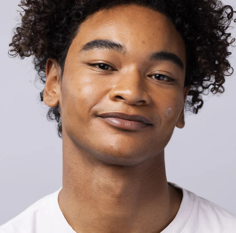 Close-up of a person with an InvisiClear Hydrocolloid pimple patch