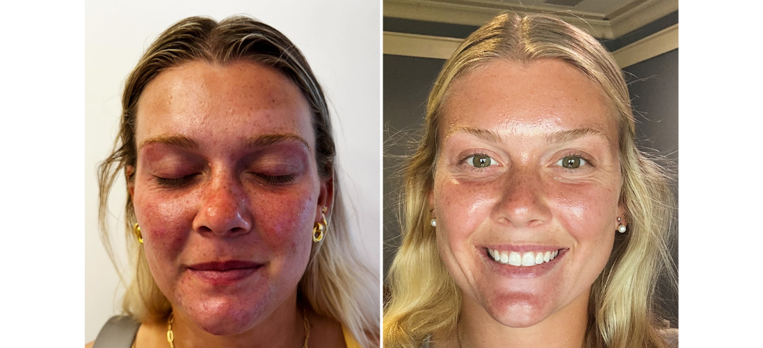 Before and after comparison of a woman's face with visible skin condition improvement.